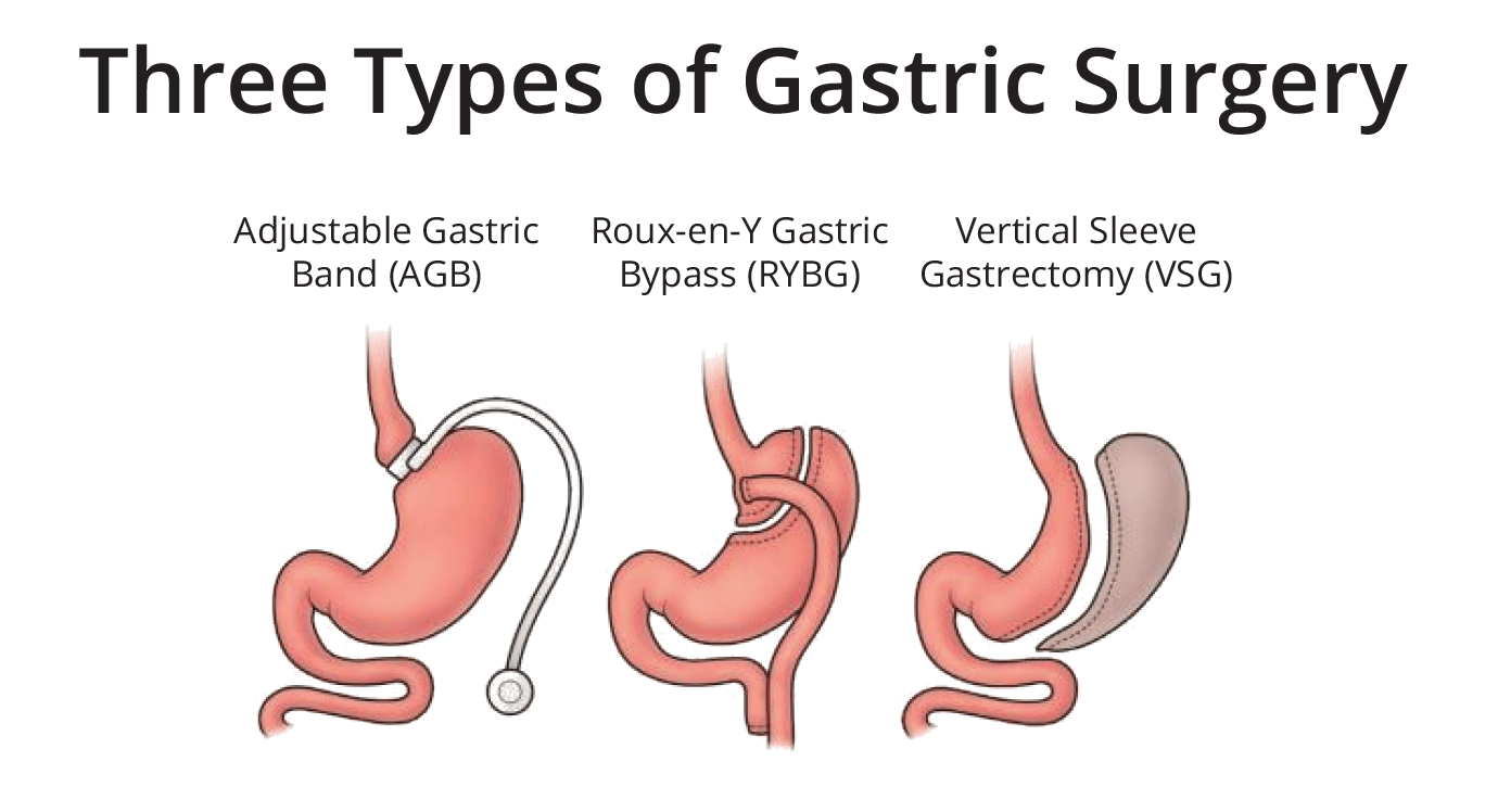 Which Bariatric Procedure is right for me? The Bariatric