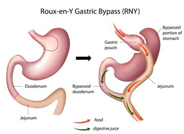 12 Months Post Gastric Bypass Surgery