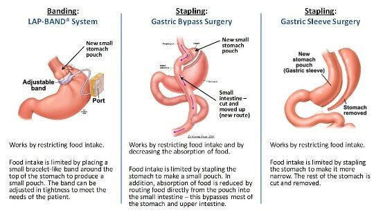 Which Bariatric Procedure is Best for Me?