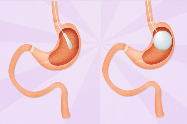 A Guide to: The gastric Balloon