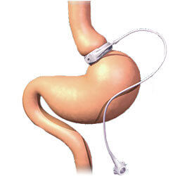 A Guide to: A Gastric Band