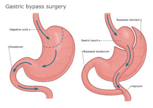 Gastric bypass uk