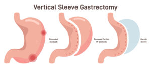 Gastric Sleeve UK